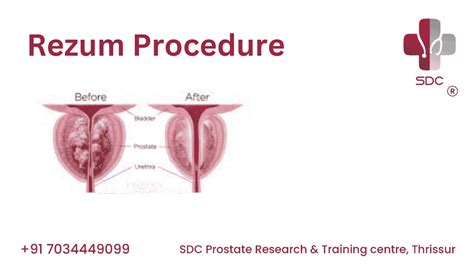 Discover the Benefits of the Rezum Procedure for Prostate Health