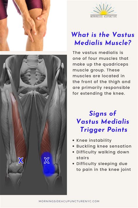 Vastus Medialis Pain Relief Guide